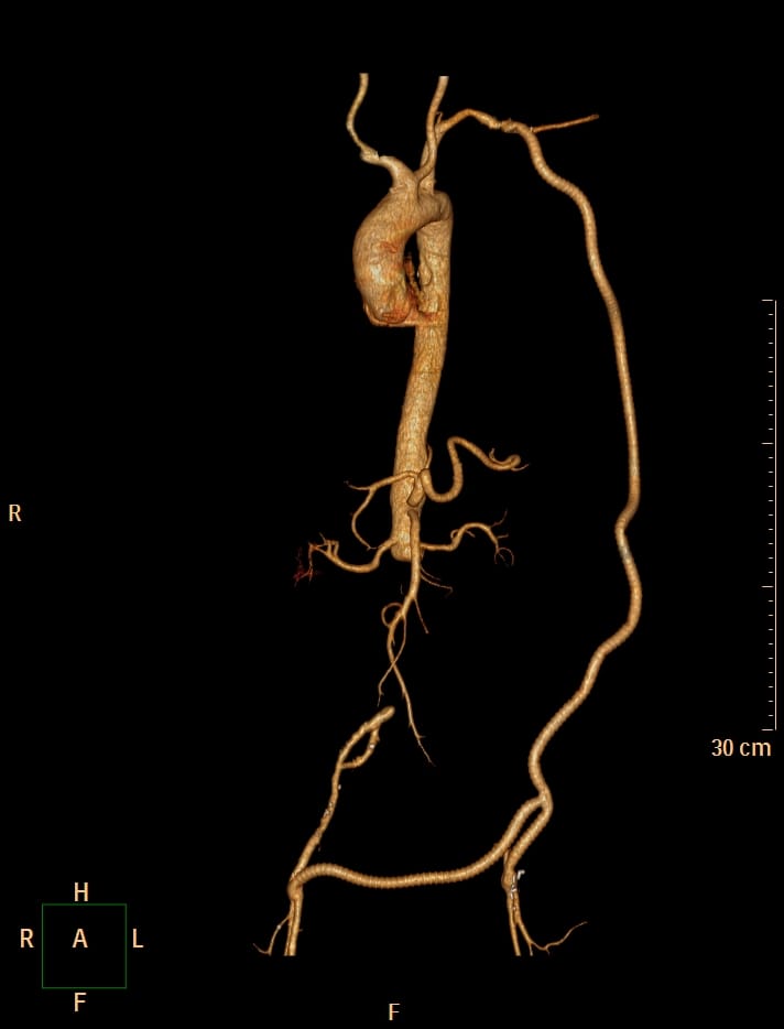 CT angiogram showing an aorto-enteric fistula