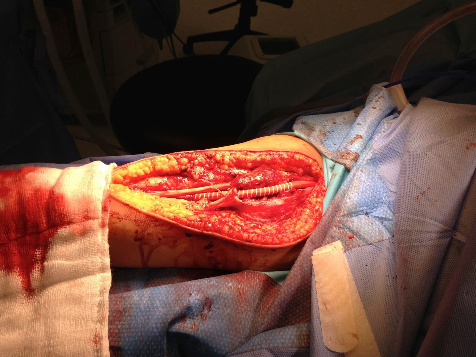 Brachial artery after open repair
