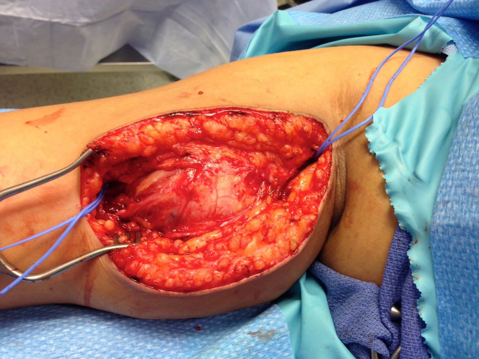 Brachial artery aneurysm before open repair