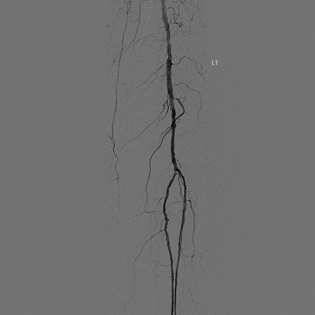 Below-the-knee artery after angioplasty