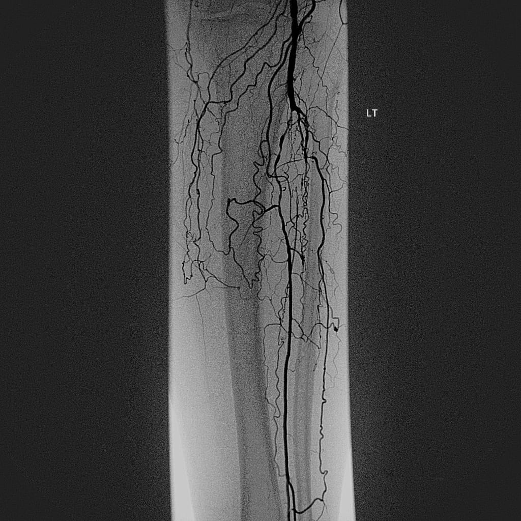 Below-the-knee arterial occlusion before angioplasty
